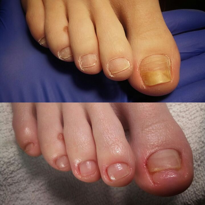 Before and after using Exodermin cream from Yesenia