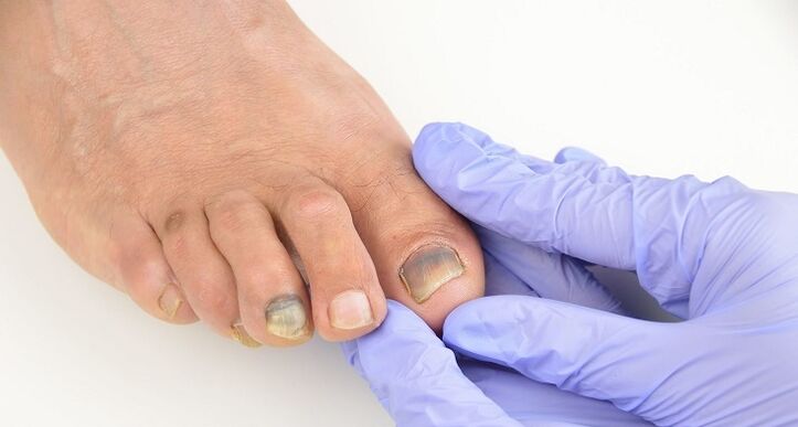 examination of toenails for fungus