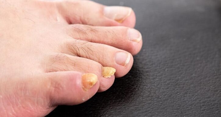 yellowing nails with nribka on the feet