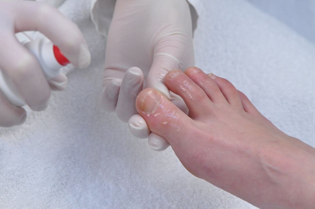 toenail treatment with fungus