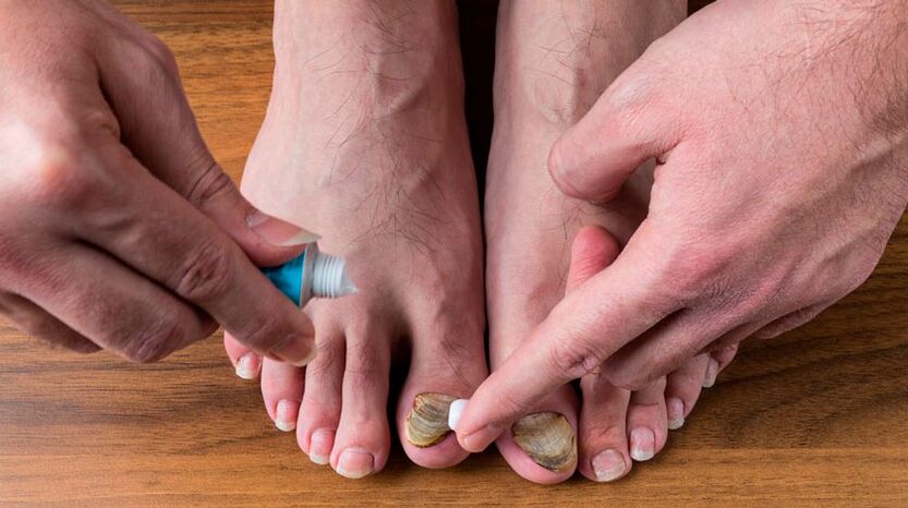 Apply an antifungal cream on your toenails to treat onychomycosis