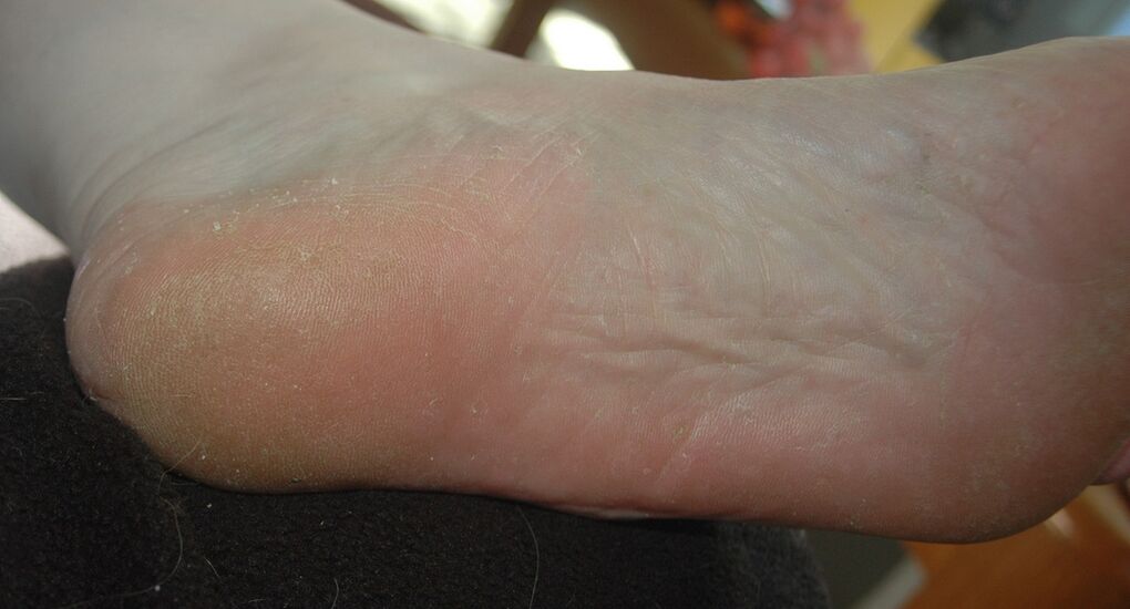 A form of foot-hyperkeratotic fungus