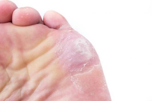 Manifestations of rubrophytosis on the skin of the feet