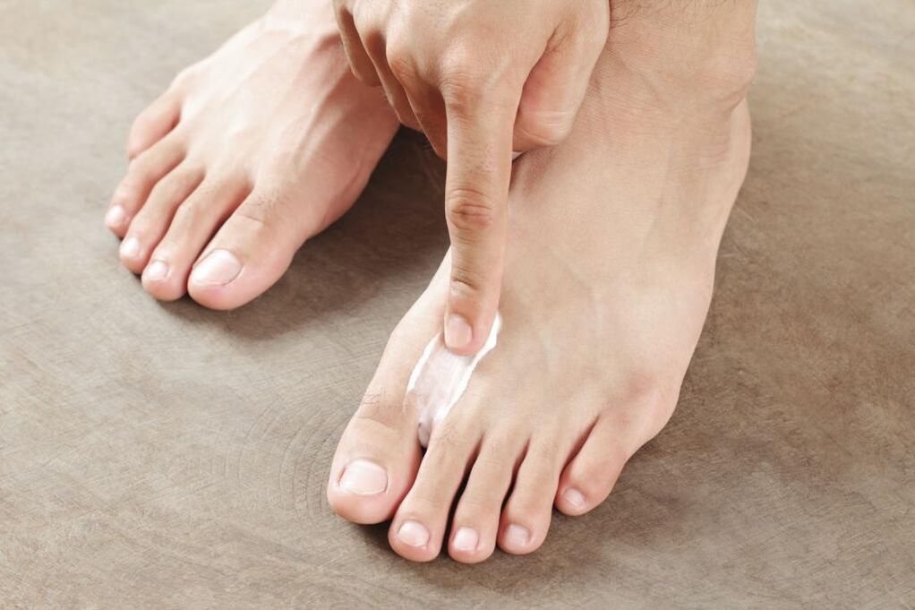 The use of special ointments to treat forms of interdigital foot fungus