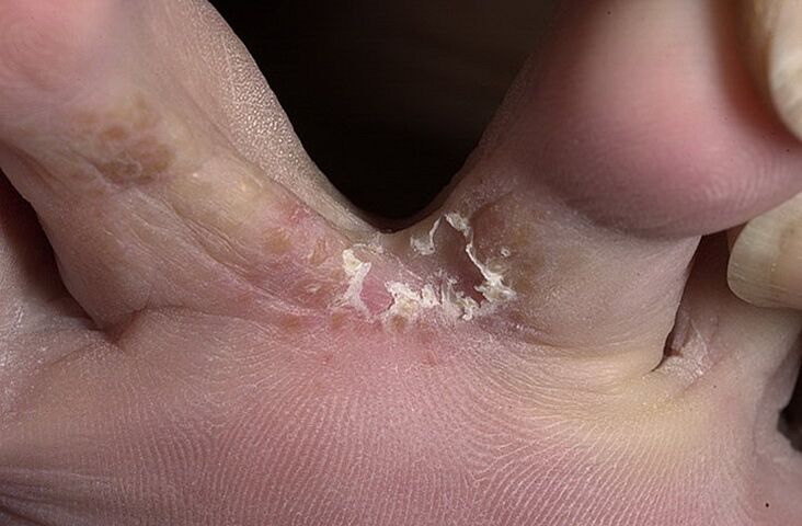 Cracked skin between the toes is a symptom of an interrelated fungus