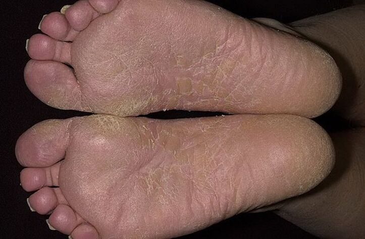 Dry and flaky foot skin is a sign of scaly mycosis