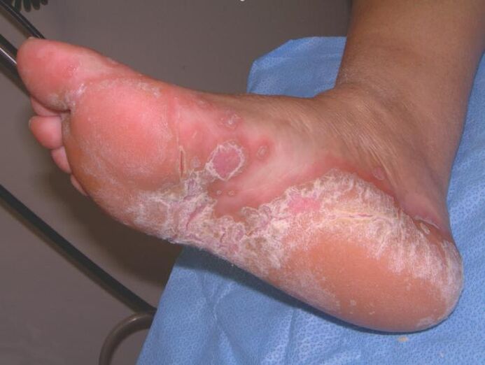 Feet affected by fungal infections