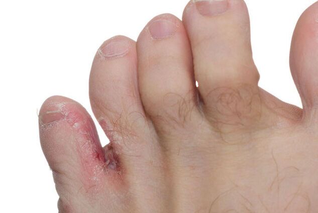 fungal symptoms between the toes