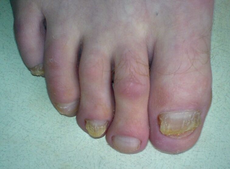 yellowing nails with fungus