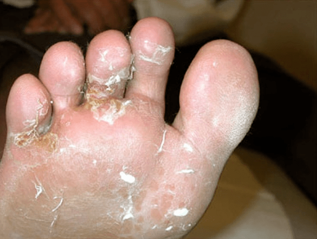 fungal development on the toes