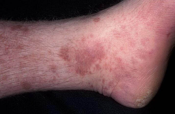 mycotic eczema of the feet