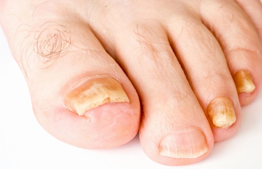 foot fungus symptoms