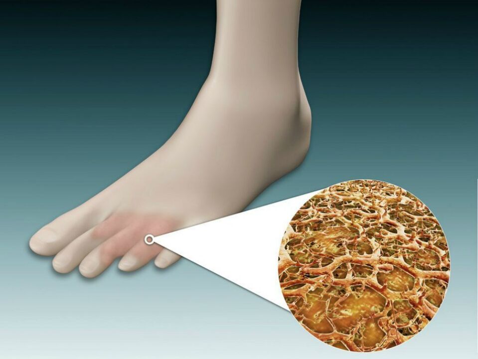 Fungal infections of the feet