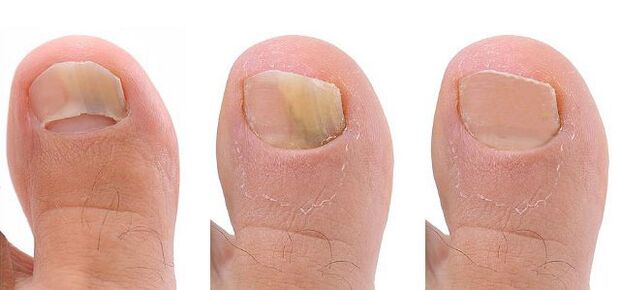 toenail fungus stage