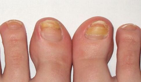 yellowing of toenails with fungus