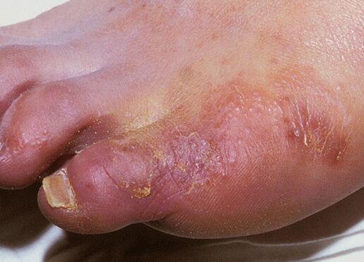 Examples of fungal infections of the feet caused by Trichophyton interdigitale