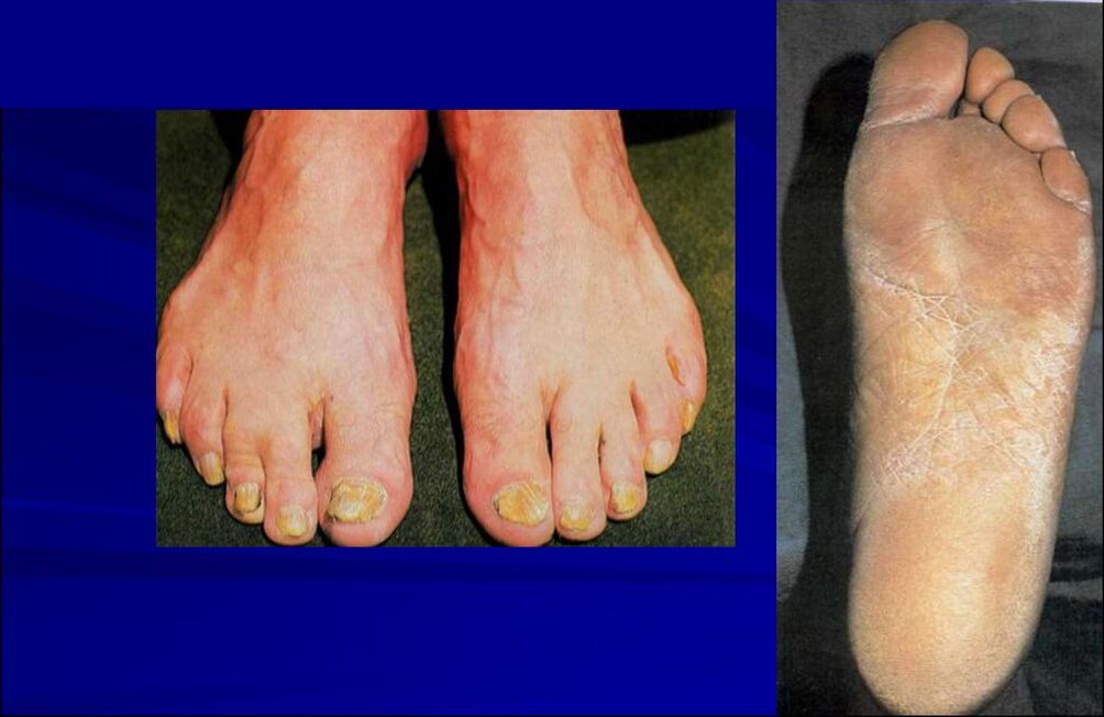 Squamous-hyperkeratotic form of fungus (foot rubromycosis)