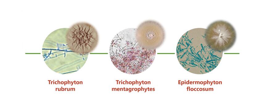 The main causative agent of skin fungus on the feet