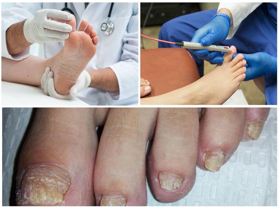 A doctor diagnoses and treats a toenail affected by a fungal infection. 