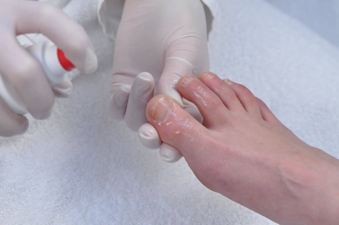 The early stage of onychomycosis is a reason to undergo a diagnostic examination by a dermatologist