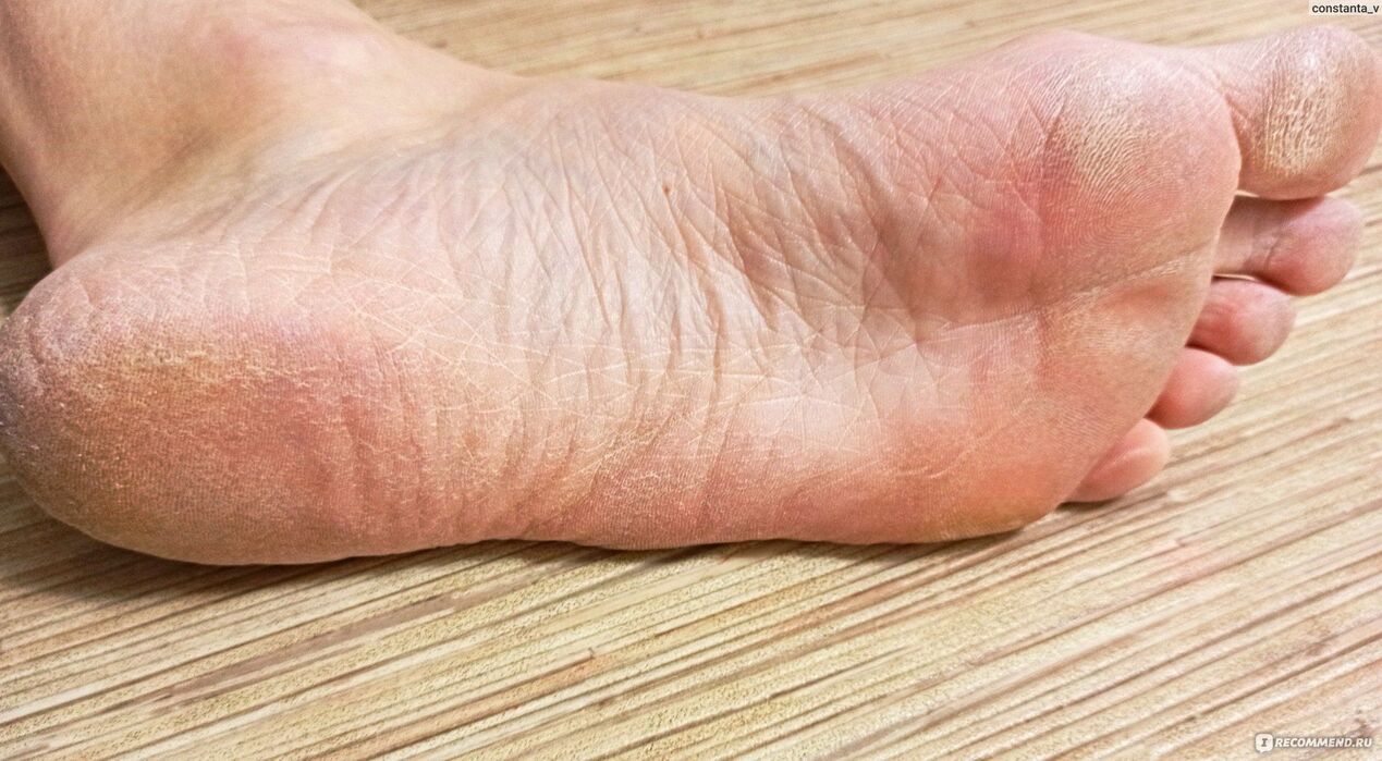 fungus on human feet