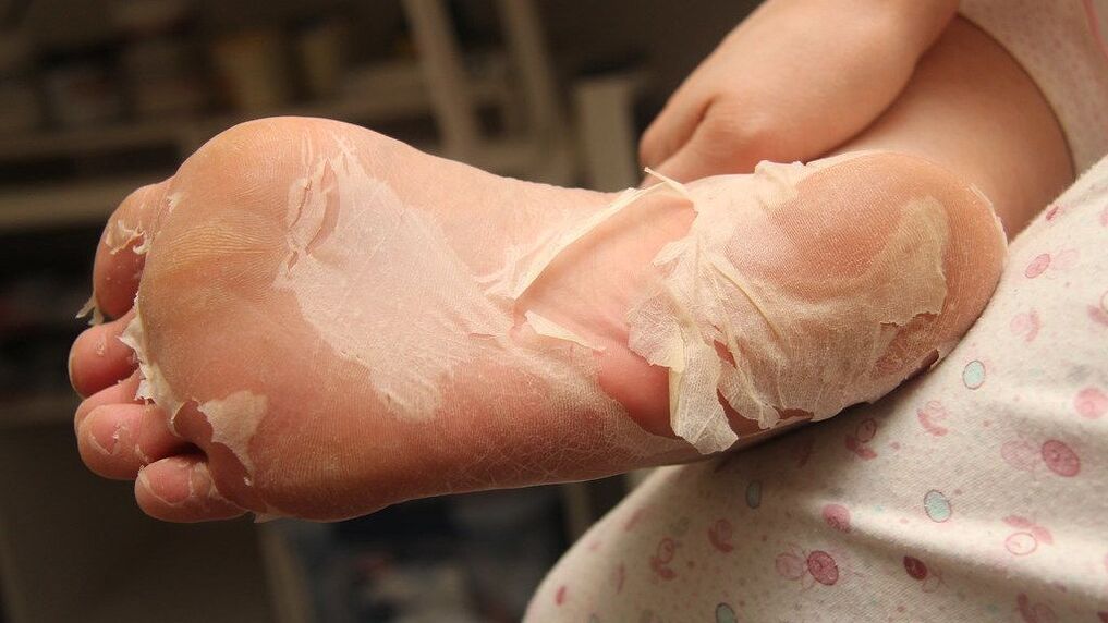 severe fungal infection of the feet